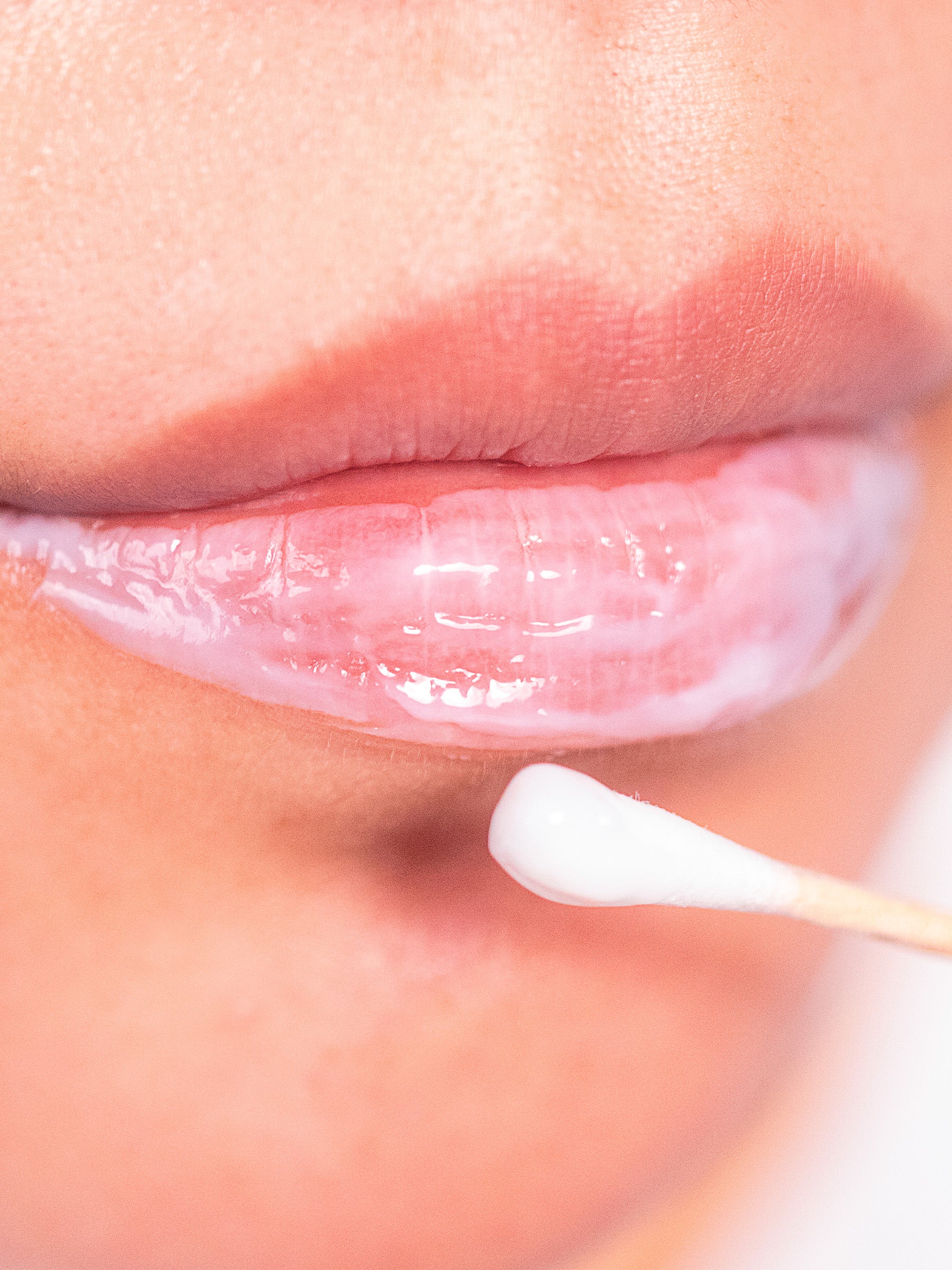 IceCream™ Topical Anesthetic