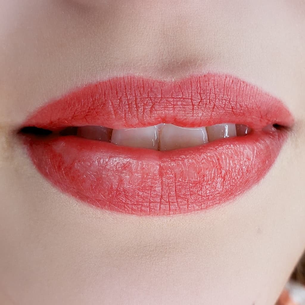 After image showing the lip area following a cosmetic procedure, close-up view
