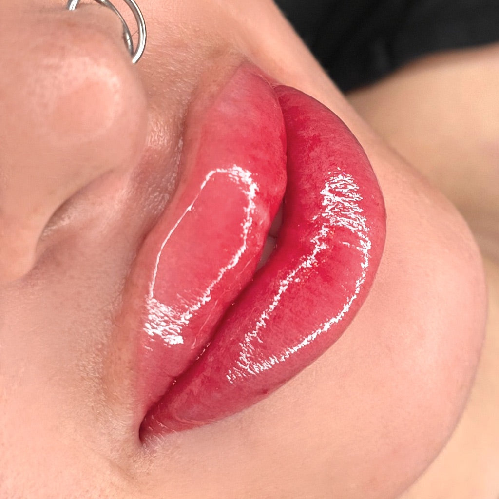 After image showing the lip area following a cosmetic procedure, close-up view