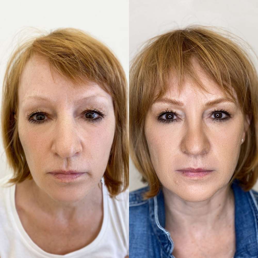 Brovi Freckle – professional permanent makeup & beauty product