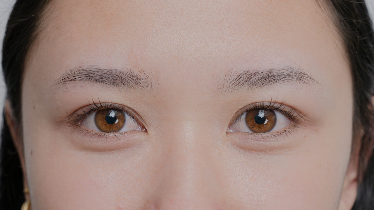 Before image showing the eyebrow area prior to a cosmetic procedure