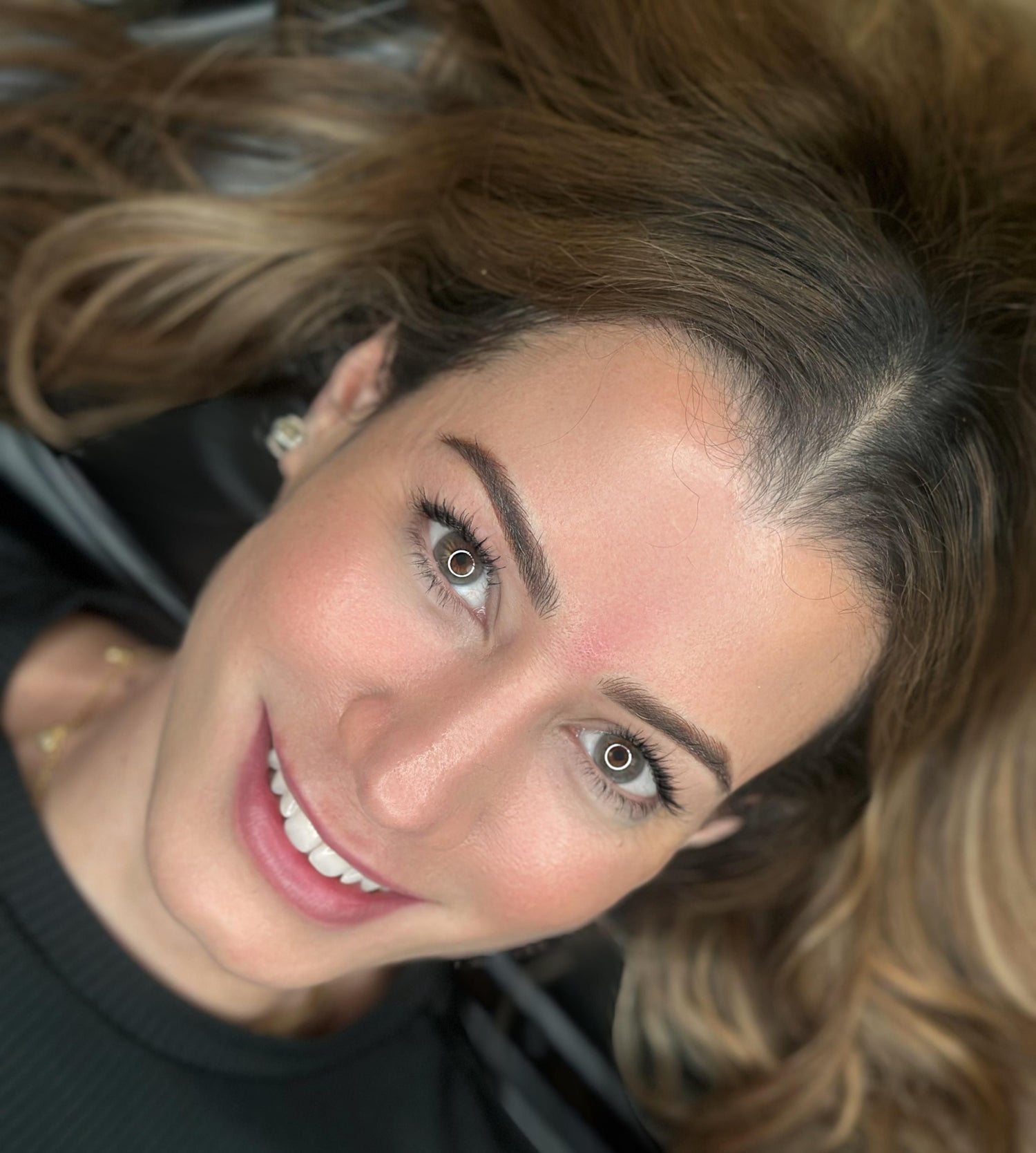 After image showing the treatment area following a cosmetic procedure
